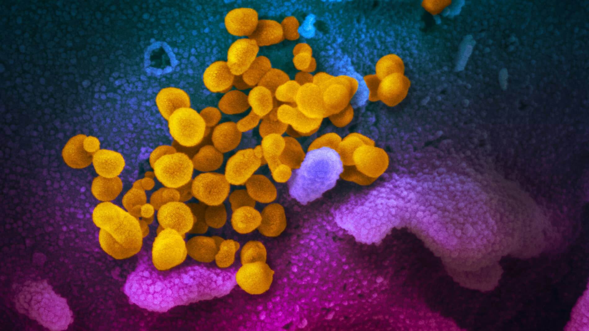Dieses Bild zeigt SARS-CoV-2 (gelb), das von einem Patienten in den USA isoliert und mit dem Raster-Elektronenmikroskop fotografiert wurde. Die blauen und rosa Flächen sind im Labor kultivierte Zellen.